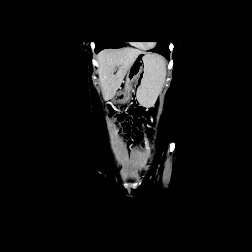 Chronic portal venous thrombosis with cavernous transformation (Radiopaedia 73618-84398 B 45).jpg