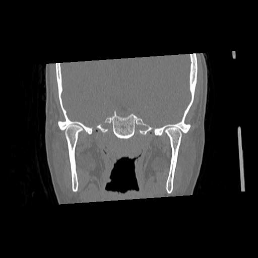 File:Chronic sinusitis with intra-sinus calcification (Radiopaedia 63919-72668 Coronal bone window 25).jpg