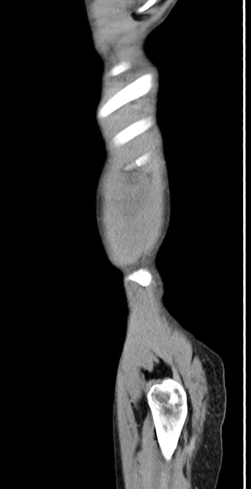 Chronic small bowel volvulus (Radiopaedia 75224-86322 C 15).jpg
