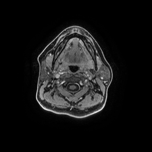 Chronic submandibular sialadenitis (Radiopaedia 61852-69885 Axial T1 C+ fat sat 67).jpg