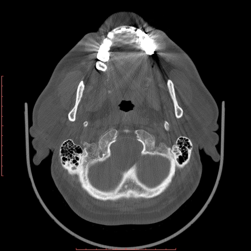 Chronic submandibular sialolithiasis (Radiopaedia 69817-79814 Axial bone window 13).jpg