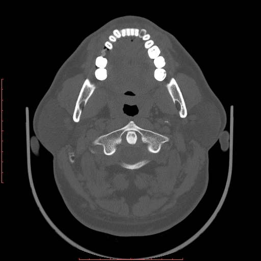 Chronic submandibular sialolithiasis (Radiopaedia 69817-79814 Axial bone window 30).jpg