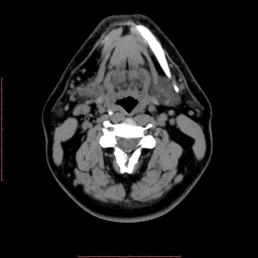 Chronic submandibular sialolithiasis (Radiopaedia 69817-79814 Axial non-contrast 116).jpg