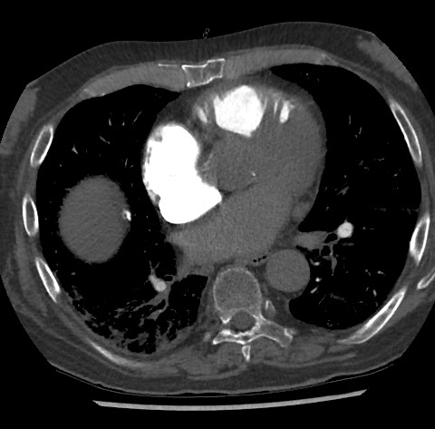 File:Chronic thromboembolic pulmonary disease (Radiopaedia 90694-108119 Axial C+ CTPA 59).jpg