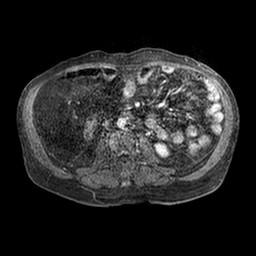 Cirrhosis and hepatocellular carcinoma in the setting of hemochromatosis (Radiopaedia 75394-86594 Axial T1 C+ fat sat 176).jpg