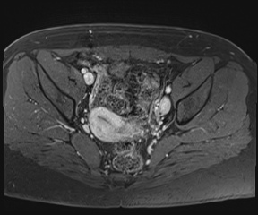 File:Class II Mullerian duct anomaly- unicornuate uterus with rudimentary horn and non-communicating cavity (Radiopaedia 39441-41755 Axial T1 fat sat 58).jpg