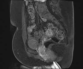 File:Class II Mullerian duct anomaly- unicornuate uterus with rudimentary horn and non-communicating cavity (Radiopaedia 39441-41755 G 62).jpg