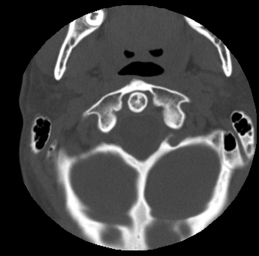 Clay-shoveler fracture (Radiopaedia 22568-22590 Axial bone window 8).jpg