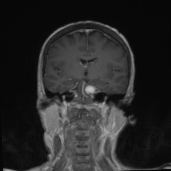 File:Clival meningioma (Radiopaedia 53278-59248 F 15).jpg