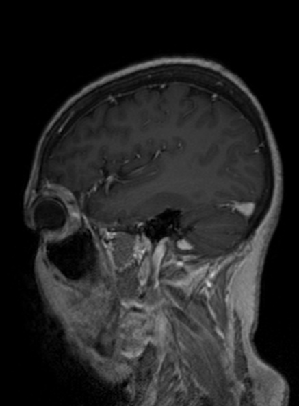 Clival meningioma (Radiopaedia 53278-59248 Sagittal T1 C+ 184).jpg