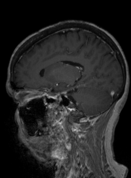 Clival meningioma (Radiopaedia 53278-59248 Sagittal T1 C+ 287).jpg