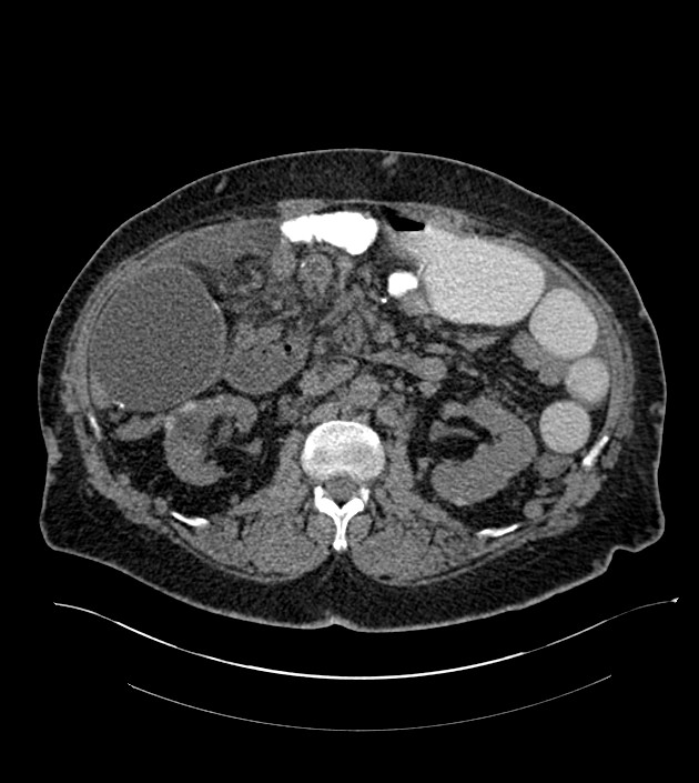 Closed-loop small bowel obstruction-internal hernia (Radiopaedia 78439-91096 Axial non-contrast 68).jpg