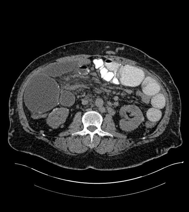 Closed-loop small bowel obstruction-internal hernia (Radiopaedia 78439-91096 Axial non-contrast 74).jpg