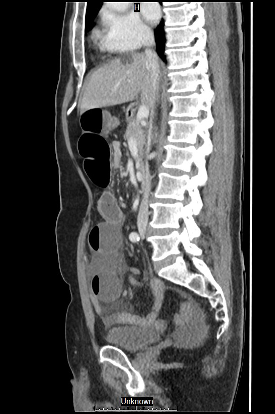 Closed loop bowel obstruction and ischemia (Radiopaedia 86959-103180 C 36).jpg