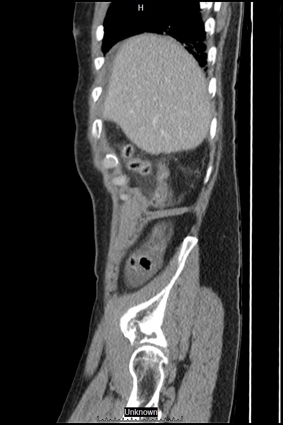 Closed loop bowel obstruction and ischemia (Radiopaedia 86959-103180 C 59).jpg
