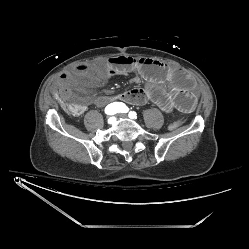 Closed loop obstruction due to adhesive band, resulting in small bowel ischemia and resection (Radiopaedia 83835-99023 B 102).jpg