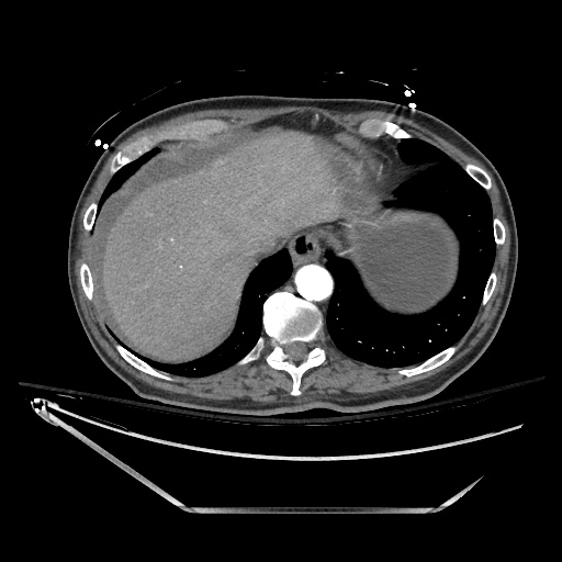 File:Closed loop obstruction due to adhesive band, resulting in small bowel ischemia and resection (Radiopaedia 83835-99023 B 25).jpg