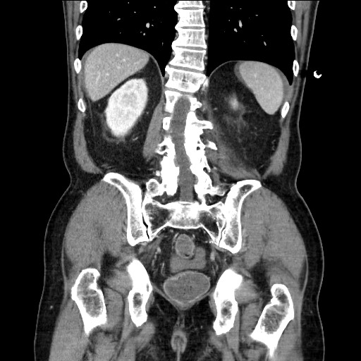 Closed loop obstruction due to adhesive band, resulting in small bowel ischemia and resection (Radiopaedia 83835-99023 E 95).jpg