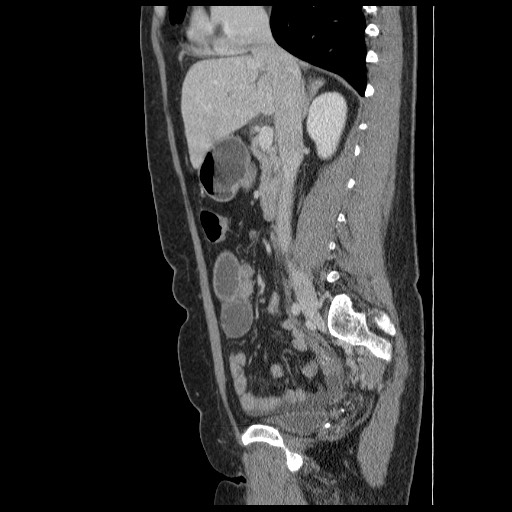 File:Closed loop small bowel obstruction (Radiopaedia 65403-74451 C 41).jpg
