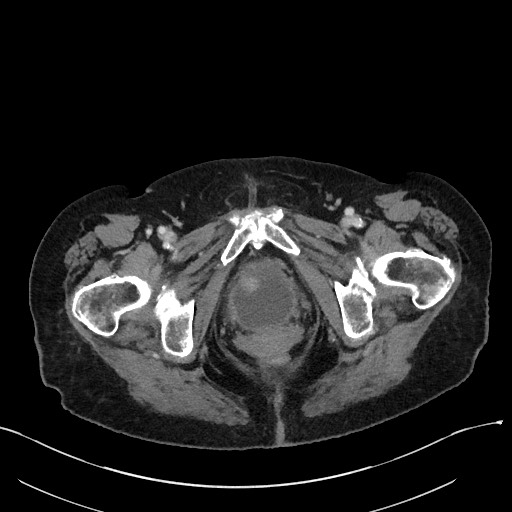 File:Closed loop small bowel obstruction - adhesions (Radiopaedia 59269-66611 Axial 112).jpg
