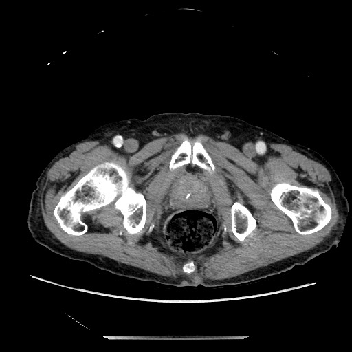 Closed loop small bowel obstruction - adhesive disease and hemorrhagic ischemia (Radiopaedia 86831-102990 A 177).jpg
