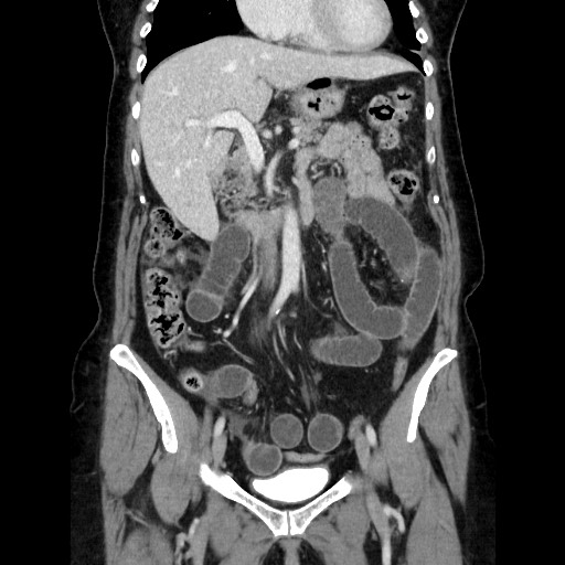 Closed loop small bowel obstruction due to adhesive bands - early and late images (Radiopaedia 83830-99015 B 53).jpg