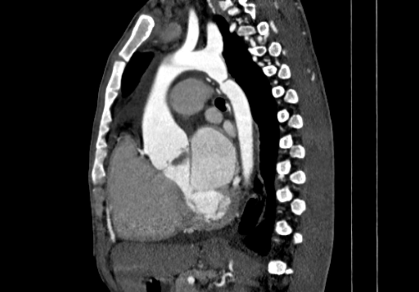Coarctation of aorta with aortic valve stenosis (Radiopaedia 70463-80574 B 81).jpg