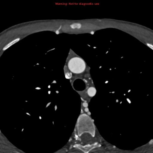 File:Coarctation of the aorta (Radiopaedia 12461-12697 A 97).jpg