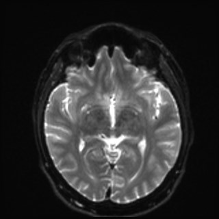Cochlear incomplete partition type III associated with hypothalamic hamartoma (Radiopaedia 88756-105498 Axial DWI 19).jpg