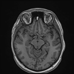 File:Cochlear incomplete partition type III associated with hypothalamic hamartoma (Radiopaedia 88756-105498 Axial T1 90).jpg