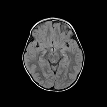 File:Cochlear nerve aplasia - unilateral (Radiopaedia 87910-104413 Axial FLAIR 15).jpg