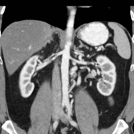 File:Collateral circulation following left renal vein thrombosis (Radiopaedia 17319-17013 renal cortical phase 13).jpg