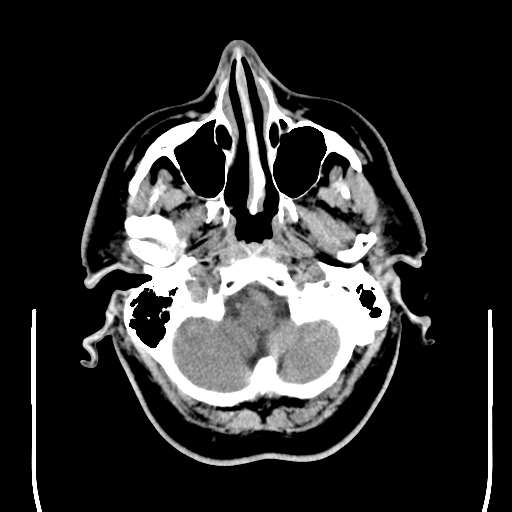 File:Colloid cyst (large) (Radiopaedia 34415-35734 Axial non-contrast 11).png