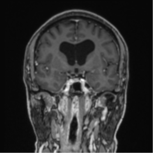 File:Colloid cyst of the third ventricle (Radiopaedia 86571-102662 Coronal T1 C+ 56).png