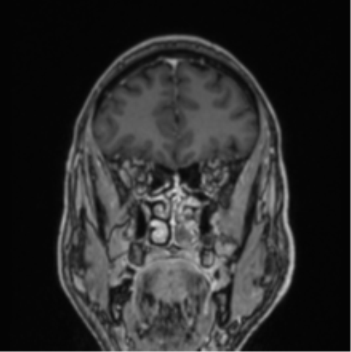 File:Colloid cyst of the third ventricle (Radiopaedia 86571-102662 Coronal T1 C+ 72).png