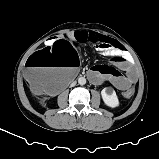 Colocolic intussusception due to large lipoma (Radiopaedia 68773-78482 A 92).jpg
