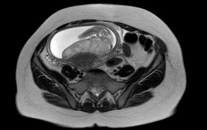 Colon adenocarcinoma with Krukenberg tumors, advanced pregnancy (Radiopaedia 67279-76645 Axial T2 25).jpg