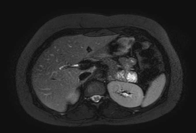 Colon adenocarcinoma with Krukenberg tumors, advanced pregnancy (Radiopaedia 67279-76645 Axial T2 SPAIR 62).jpg
