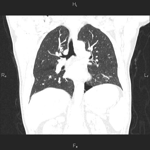 File:Colon cancer (Radiopaedia 85663-101443 Axial lung window 1).jpg