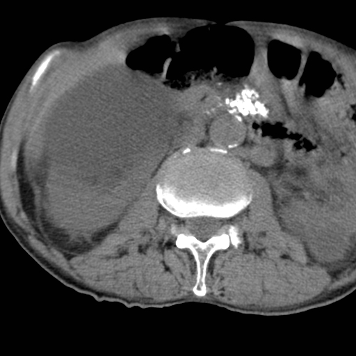 Colon cancer with calcified liver metastasis (Radiopaedia 74423-85309 Axial non-contrast 44).jpg