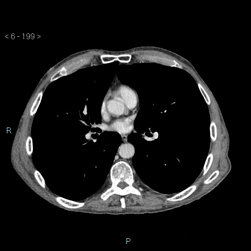 File:Colonic cancer (ultrasound and TC imaging) (Radiopaedia 50346-55713 B 199).jpg