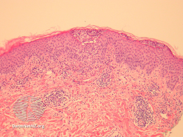 File:Figure 1 (DermNet NZ pathology-e-agep-fig-1).jpg