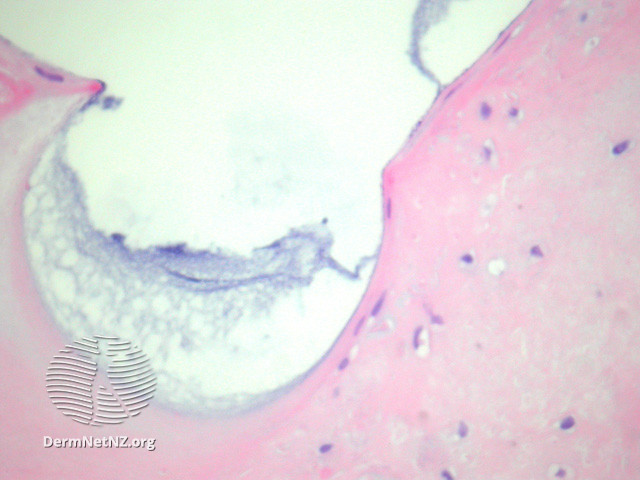 File:Figure 3 (DermNet NZ pathology-e-auricle-pseudocyst-figure-3).jpg