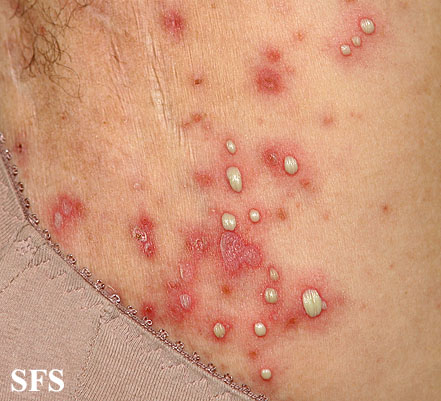 File:Impetigo (Dermatology Atlas 41).jpg