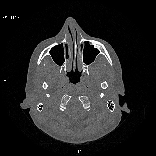 Nasolabial cyst (Radiopaedia 75125-86194 Axial bone window 71).jpg