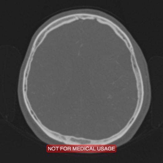 File:Nasopharyngeal carcinoma recurrence - skull base destruction (Radiopaedia 29107-29490 Axial bone window 41).jpg