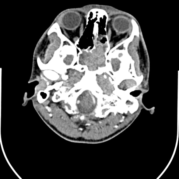Nasopharyngeal carcinoma with skull base invasion (Radiopaedia 53415-59705 A 25).jpg
