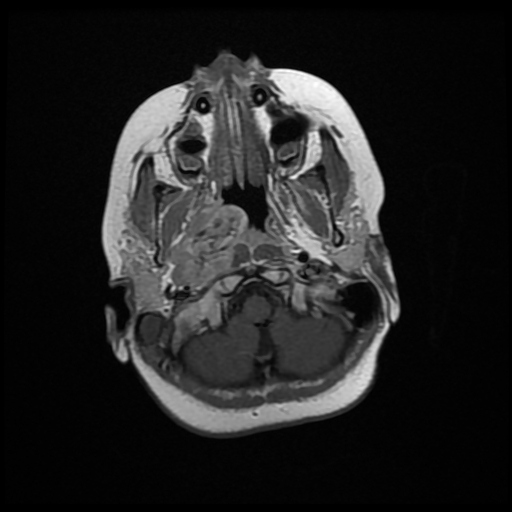 File:Nasopharyngeal rhabdomyosarcoma (Radiopaedia 23417-23486 Axial T1 C+ 3).jpg