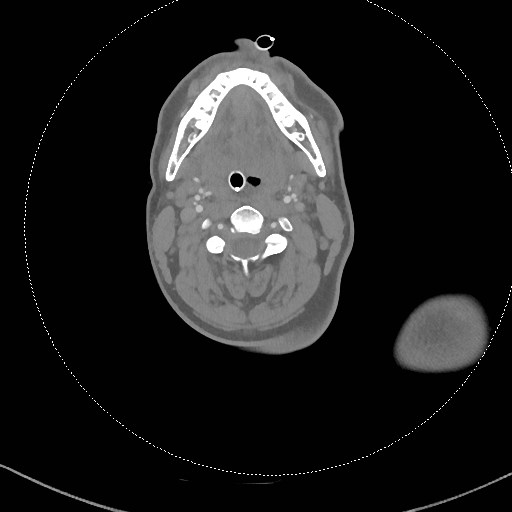 Neck CT angiogram (intraosseous vascular access) (Radiopaedia 55481-61945 B 204).jpg