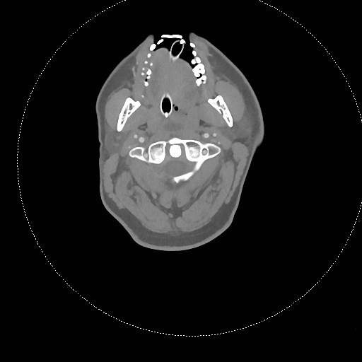 Neck CT angiogram (intraosseous vascular access) (Radiopaedia 55481-61945 B 225).jpg